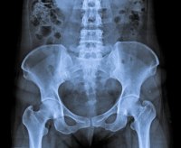 X-Rays More Reliable Than Visual Analysis for Detecting Pelvic Misalignments